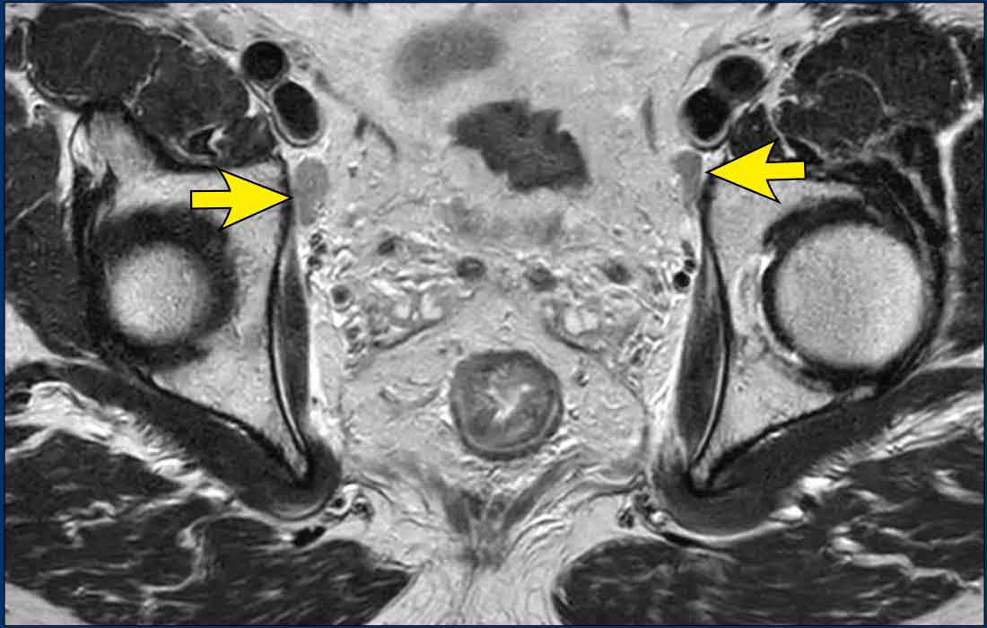 Benign nodes dorsal from the external iliac veins