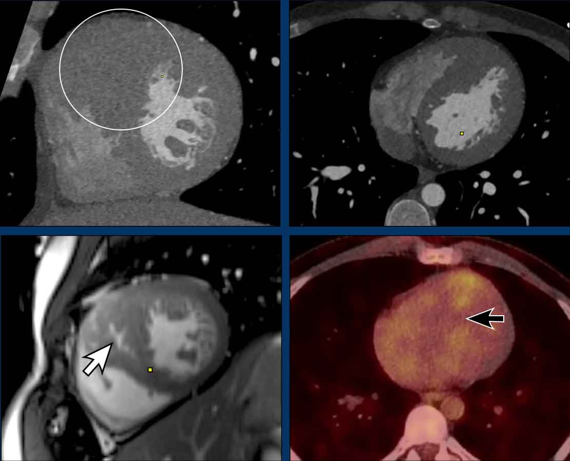 Obstructive hypertrophic cardiomyopathy (HOCM) with asymmetric myocardial thickening