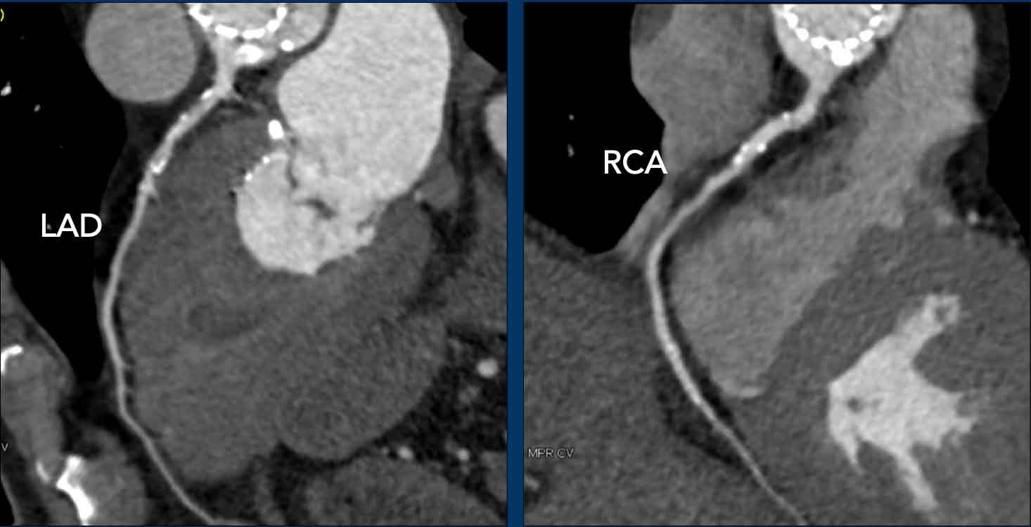 Coronary obstruction was suspected. None was seen on post TAVI CT.