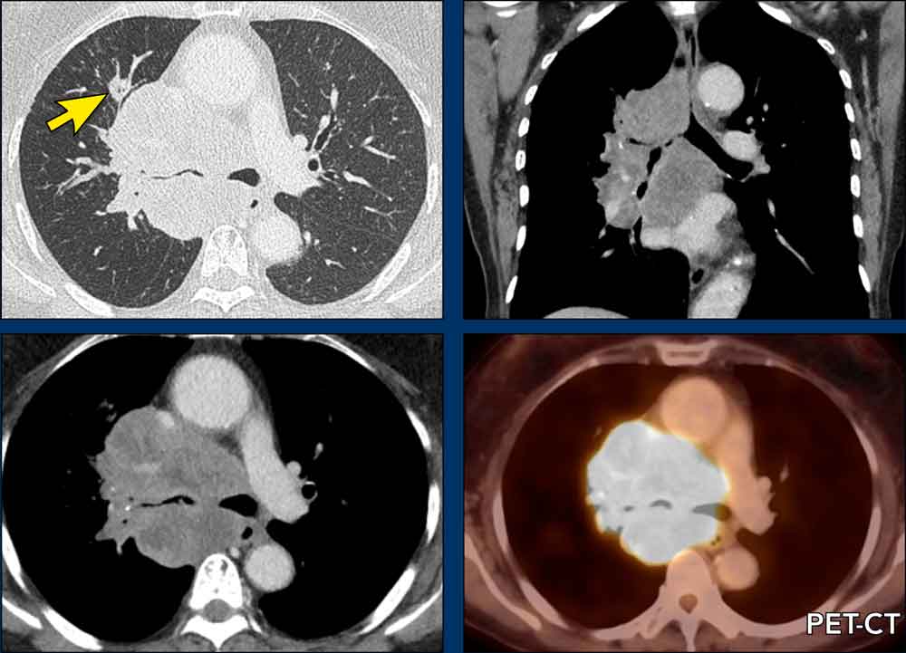 Small cell lung cancer