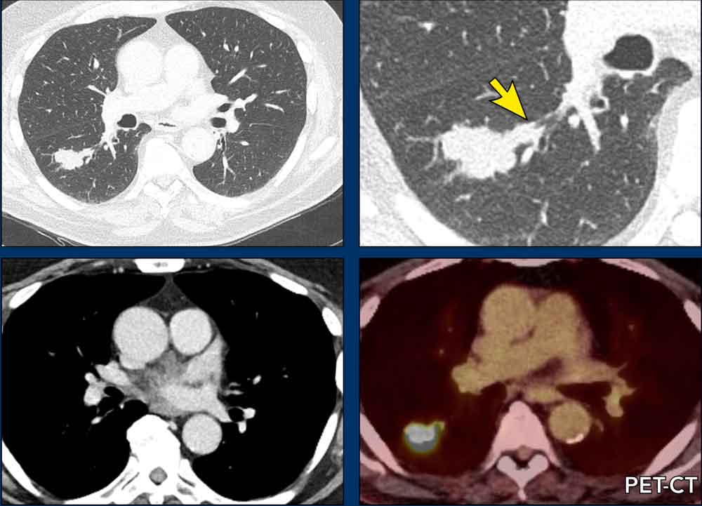 Squamous cell carcinoma. No lymphadenopathy.