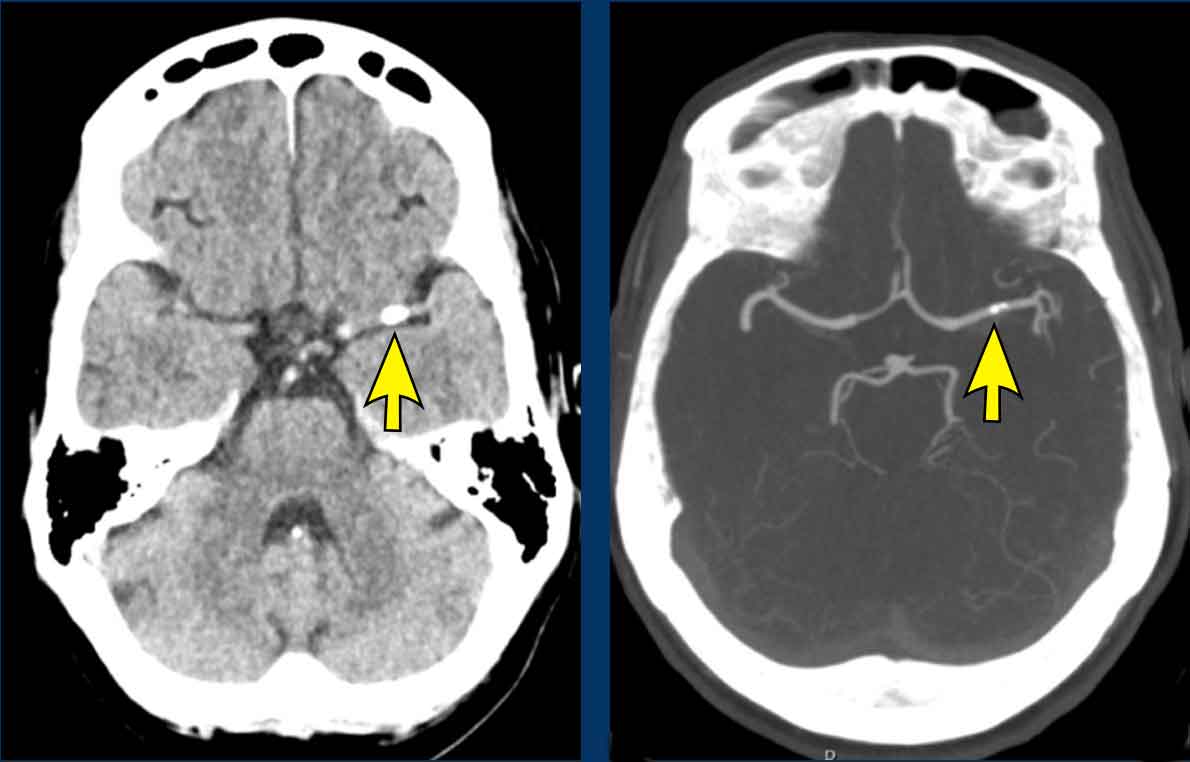 Calcified thrombus in left M1 (arrow). Minutes after TAVI procedure dysarthria and weakness of the right arm and right leg were observed. Patient recovered without intervention.