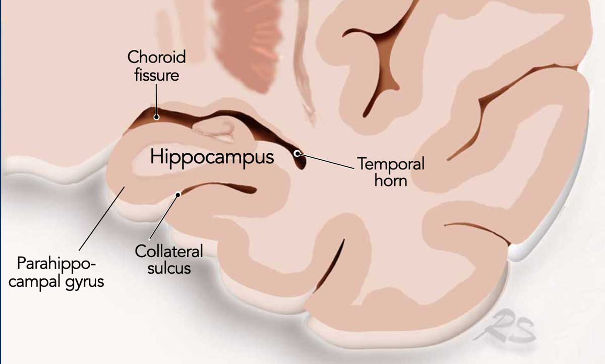 Coronal image of the hippocampus.
