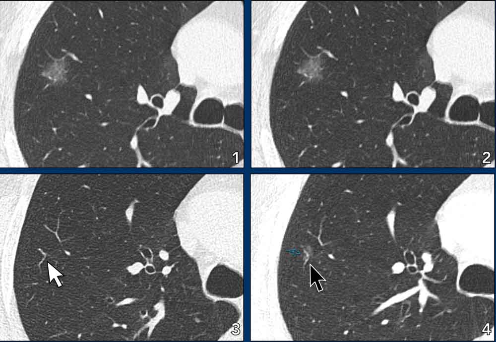 Subtle progression of adenocarcinoma with lepidic growth