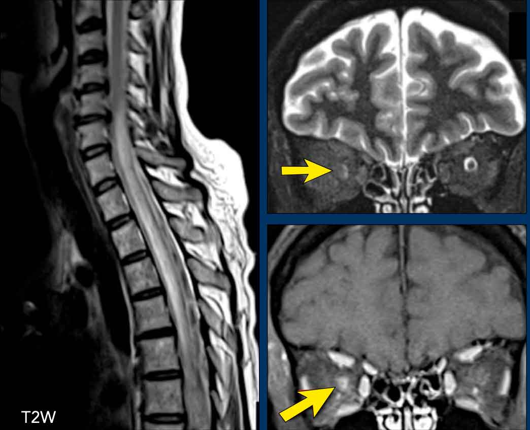 Patient with NMOSD showing a longitudinally extensive cord lesion with marked swelling. Right-sided neuritis optica. The diagnosis was confirmed by an AQP4-AB titer of 1:1024.