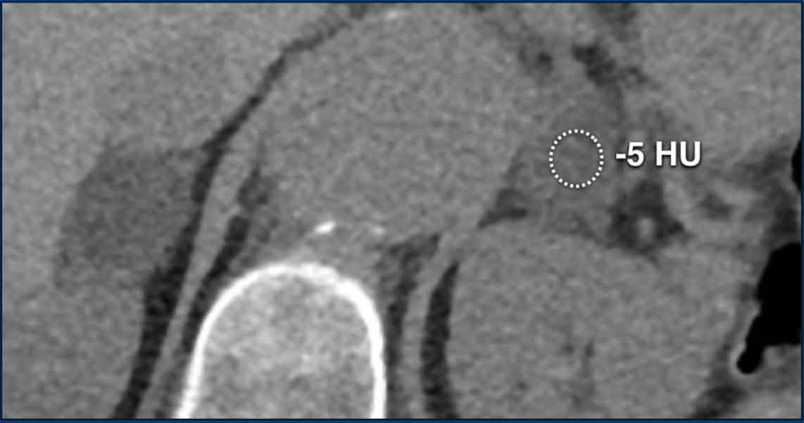 Lipid-rich adenoma