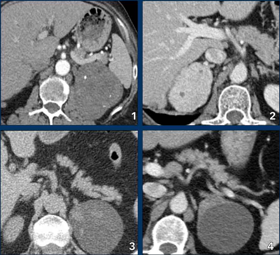 Atypical lesions that prooved to be adenomas
