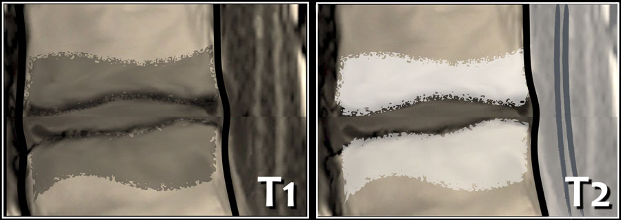 The Radiology Assistant : Lumbar Disc Nomenclature 2.0