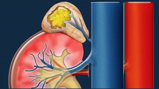 Characterization of Adrenal lesions - Update